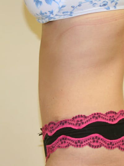Tummy Tuck Before & After Gallery - Patient 9605583 - Image 6