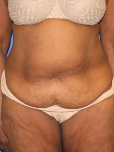 Tummy Tuck Before & After Gallery - Patient 9605584 - Image 1