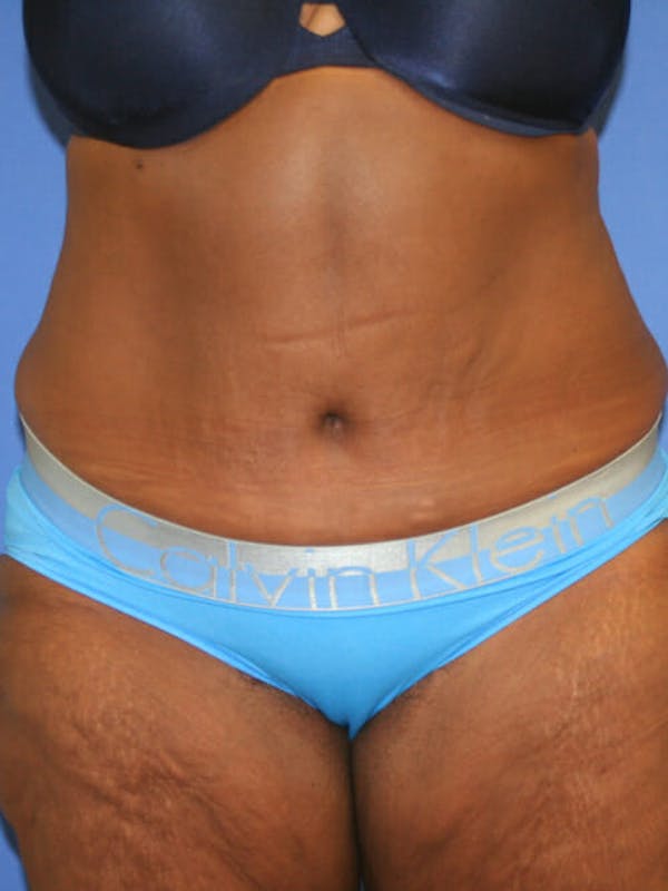 Tummy Tuck Before & After Gallery - Patient 9605584 - Image 2