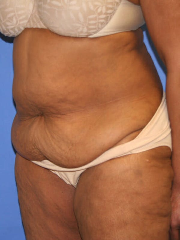 Tummy Tuck Before & After Gallery - Patient 9605584 - Image 3