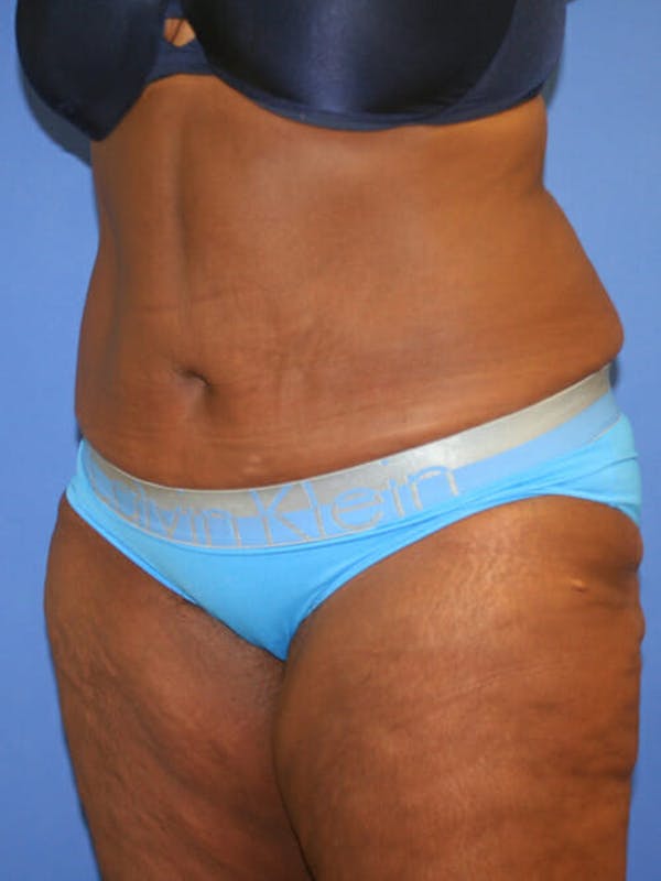 Tummy Tuck Gallery - Patient 9605584 - Image 4