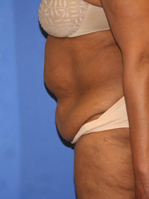 Tummy Tuck Before & After Gallery - Patient 9605584 - Image 5