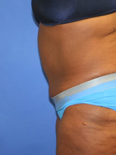 Tummy Tuck Before & After Gallery - Patient 9605584 - Image 6