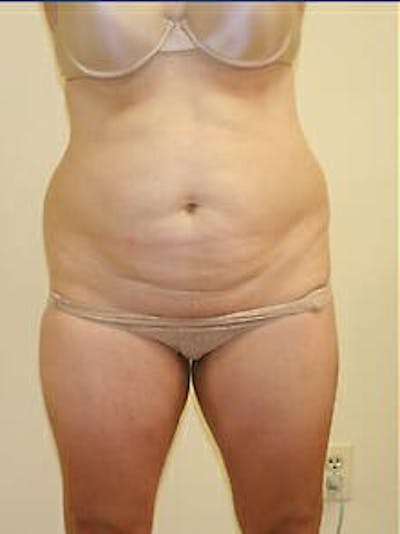 Tummy Tuck Before & After Gallery - Patient 9605586 - Image 1