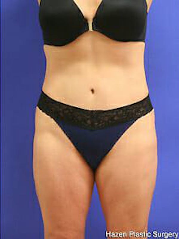 Tummy Tuck Before & After Gallery - Patient 9605586 - Image 2