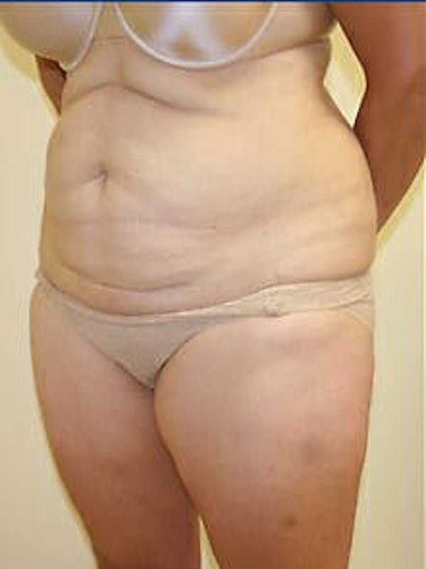 Tummy Tuck Before & After Gallery - Patient 9605586 - Image 3