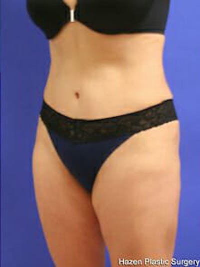 Tummy Tuck Before & After Gallery - Patient 9605586 - Image 4