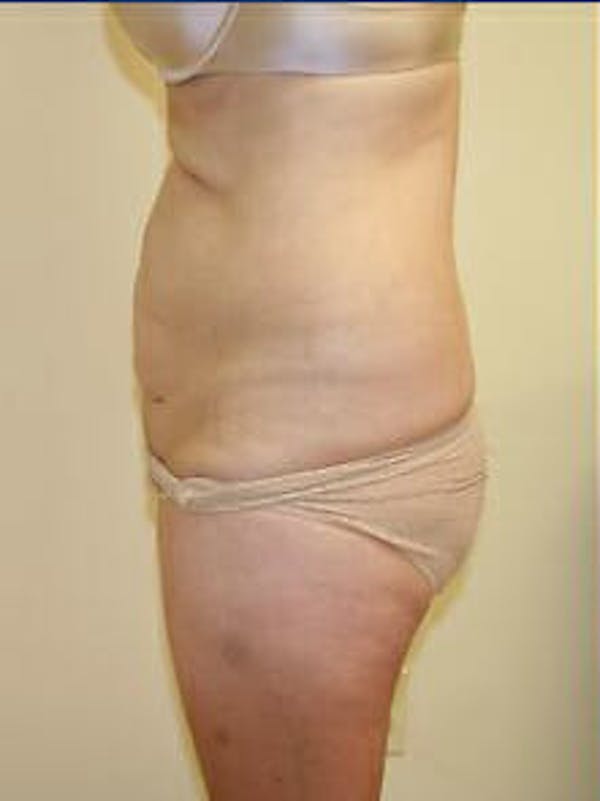 Tummy Tuck Before & After Gallery - Patient 9605586 - Image 5