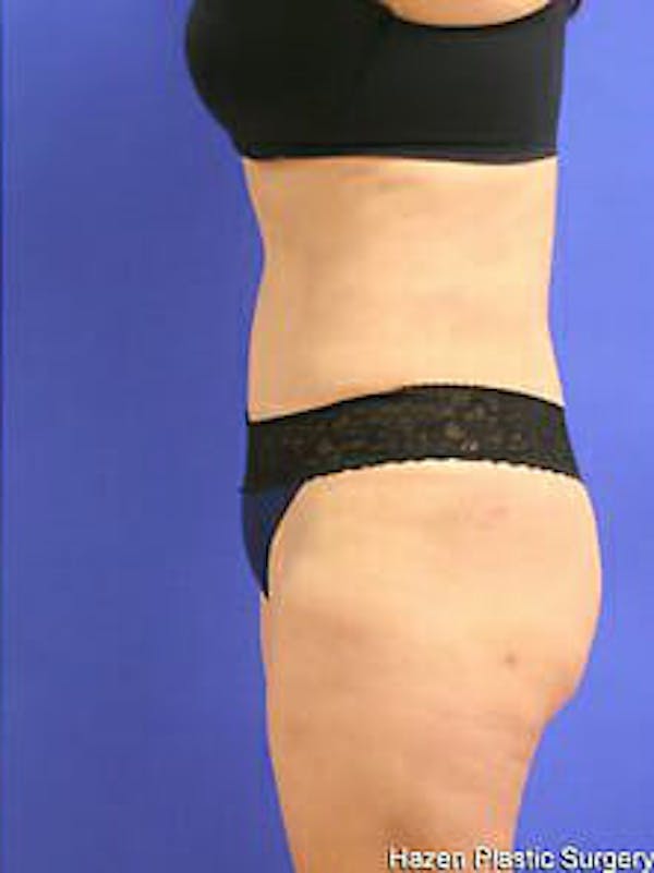 Tummy Tuck Before & After Gallery - Patient 9605586 - Image 6