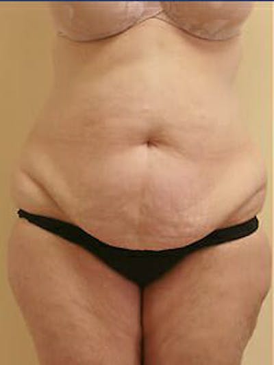 Tummy Tuck Before & After Gallery - Patient 9605589 - Image 1