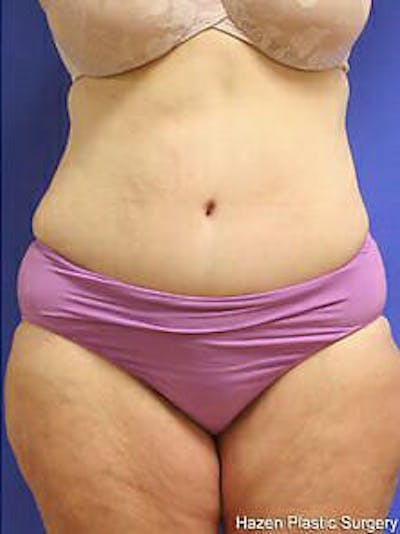 Tummy Tuck Before & After Gallery - Patient 9605589 - Image 2