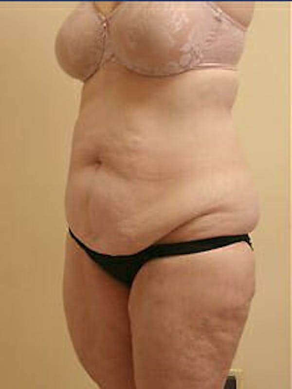 Tummy Tuck Before & After Gallery - Patient 9605589 - Image 3