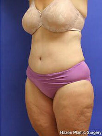 Tummy Tuck Before & After Gallery - Patient 9605589 - Image 4