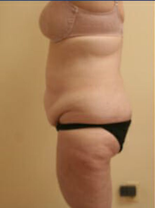 Tummy Tuck Before & After Gallery - Patient 9605589 - Image 5