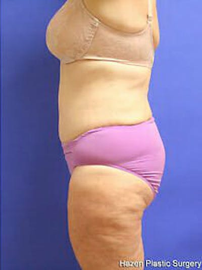 Tummy Tuck Before & After Gallery - Patient 9605589 - Image 6