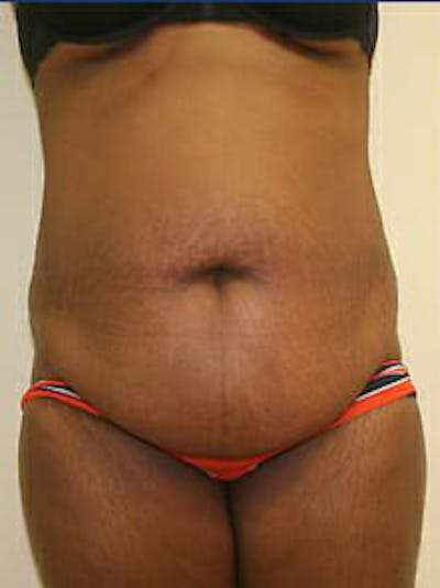 Tummy Tuck Before & After Gallery - Patient 9605594 - Image 1