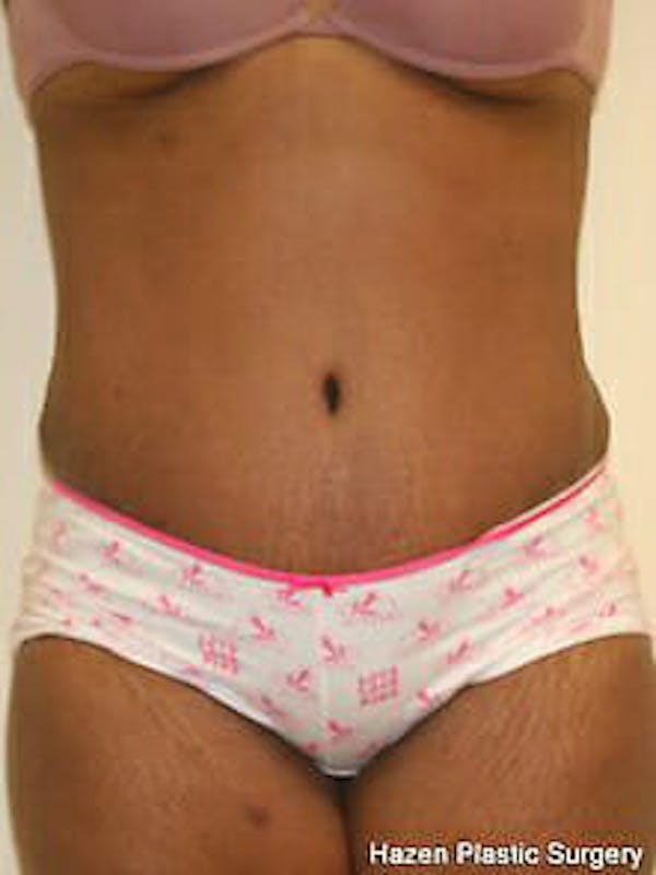 Tummy Tuck Gallery - Patient 9605594 - Image 2