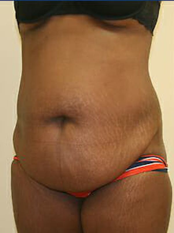 Tummy Tuck Before & After Gallery - Patient 9605594 - Image 3