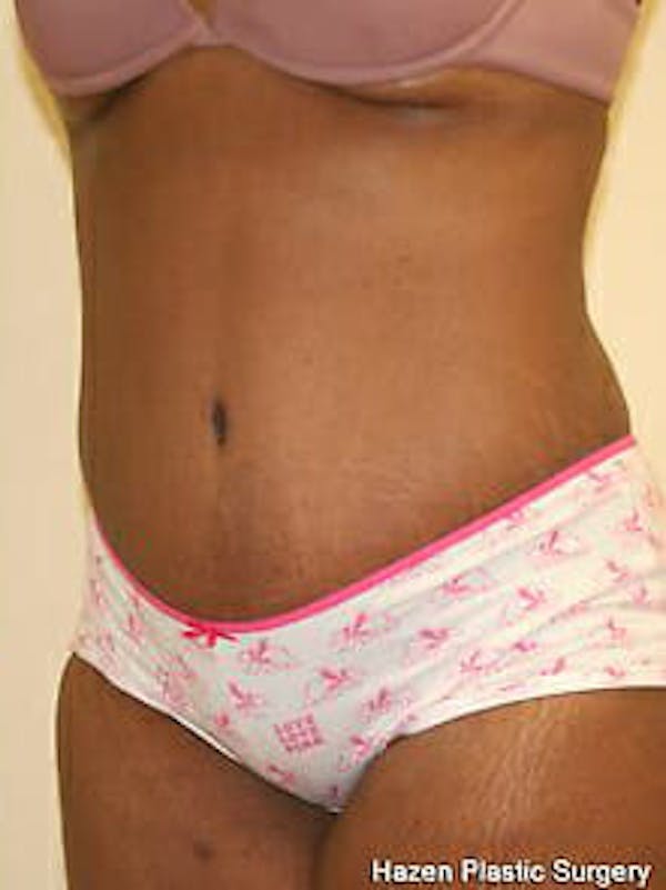 Tummy Tuck Before & After Gallery - Patient 9605594 - Image 4