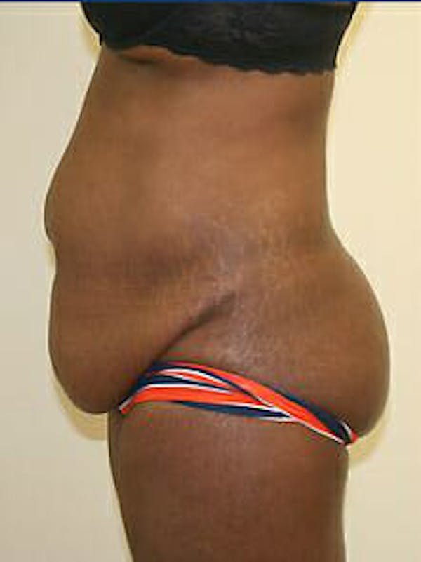 Tummy Tuck Before & After Gallery - Patient 9605594 - Image 5