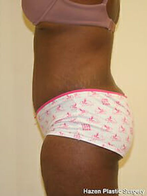 Tummy Tuck Before & After Gallery - Patient 9605594 - Image 6