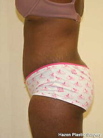 Tummy Tuck Before & After Gallery - Patient 9605594 - Image 6