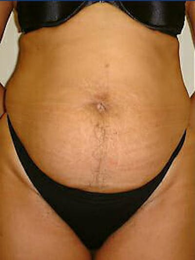 Tummy Tuck Before & After Gallery - Patient 9605602 - Image 1
