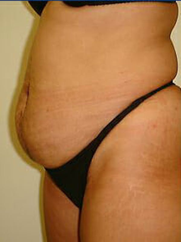 Tummy Tuck Before & After Gallery - Patient 9605602 - Image 3