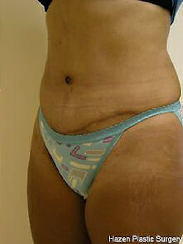 Tummy Tuck Gallery - Patient 9605602 - Image 4