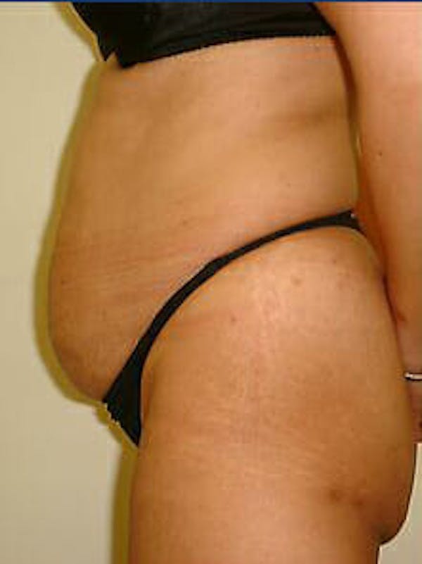 Tummy Tuck Before & After Gallery - Patient 9605602 - Image 5