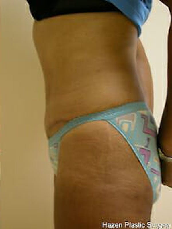 Tummy Tuck Before & After Gallery - Patient 9605602 - Image 6