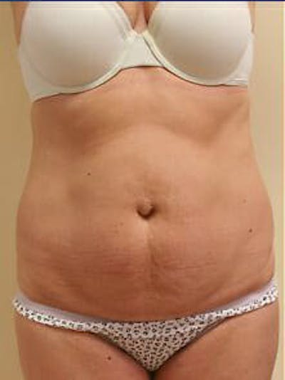 Tummy Tuck Before & After Gallery - Patient 9605603 - Image 1