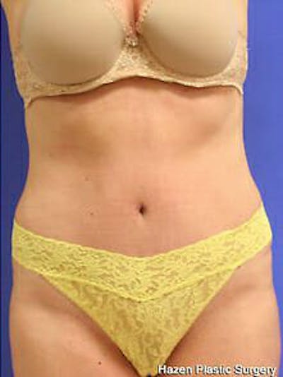 Tummy Tuck Before & After Gallery - Patient 9605603 - Image 2