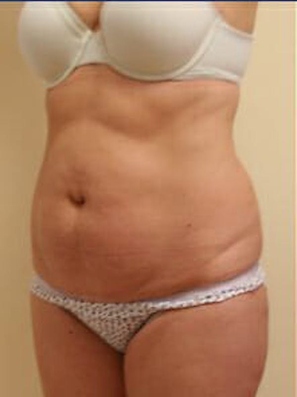 Tummy Tuck Before & After Gallery - Patient 9605603 - Image 3