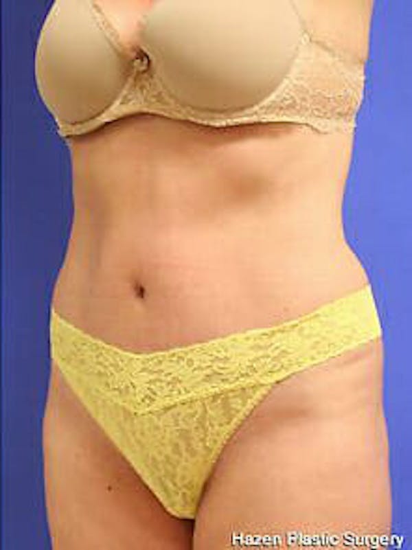 Tummy Tuck Before & After Gallery - Patient 9605603 - Image 4
