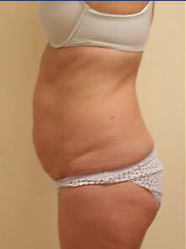 Tummy Tuck Before & After Gallery - Patient 9605603 - Image 5