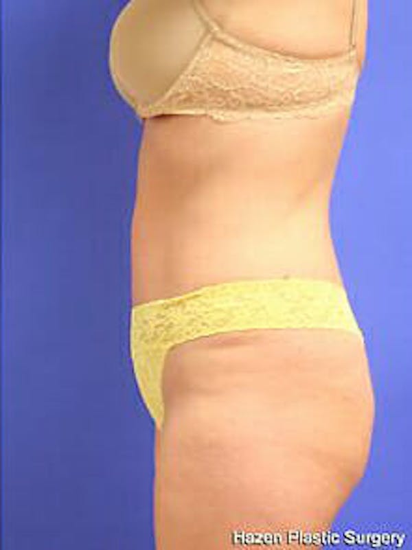 Tummy Tuck Before & After Gallery - Patient 9605603 - Image 6