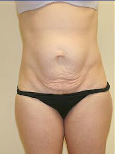 Tummy Tuck Before & After Gallery - Patient 9605606 - Image 1