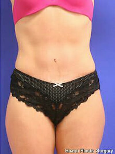Tummy Tuck Before & After Gallery - Patient 9605606 - Image 2