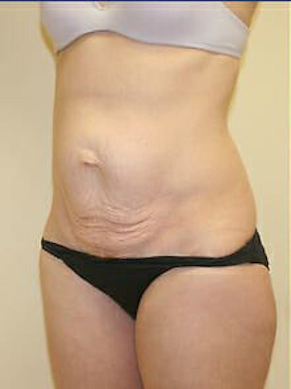 Tummy Tuck Before & After Gallery - Patient 9605606 - Image 3
