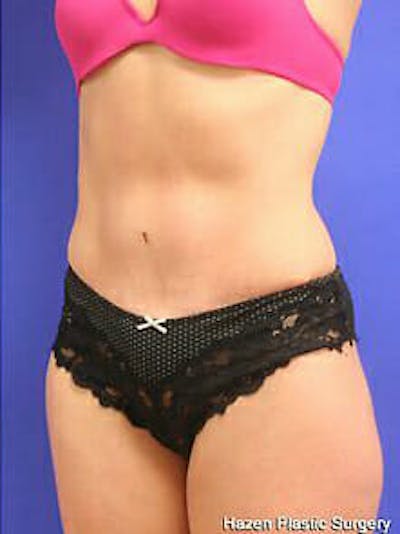 Tummy Tuck Before & After Gallery - Patient 9605606 - Image 4
