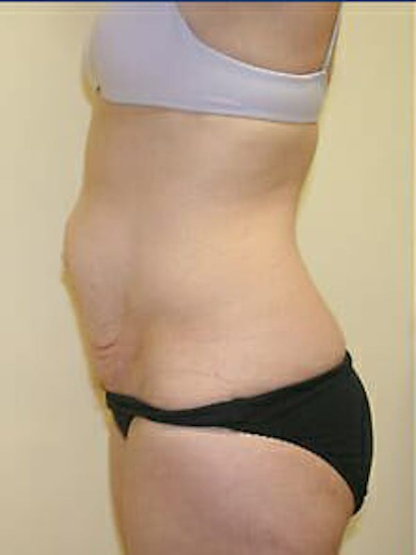 Tummy Tuck Before & After Gallery - Patient 9605606 - Image 5