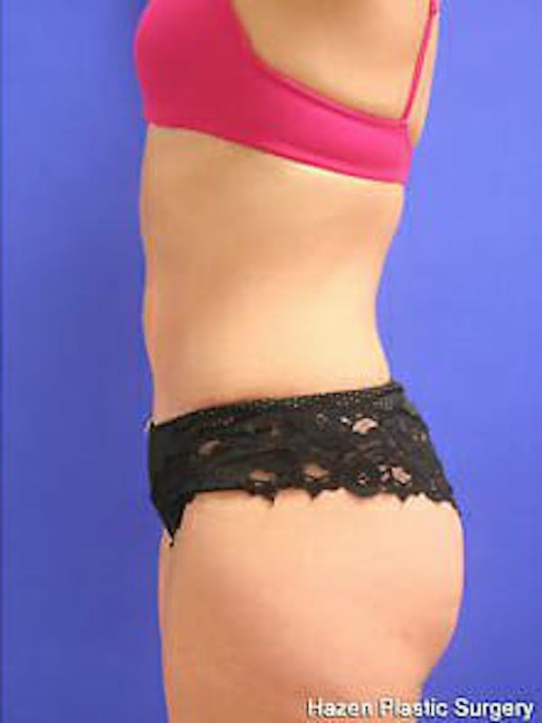 Tummy Tuck Before & After Gallery - Patient 9605606 - Image 6
