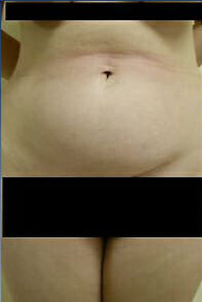 Tummy Tuck Before & After Gallery - Patient 9605609 - Image 1