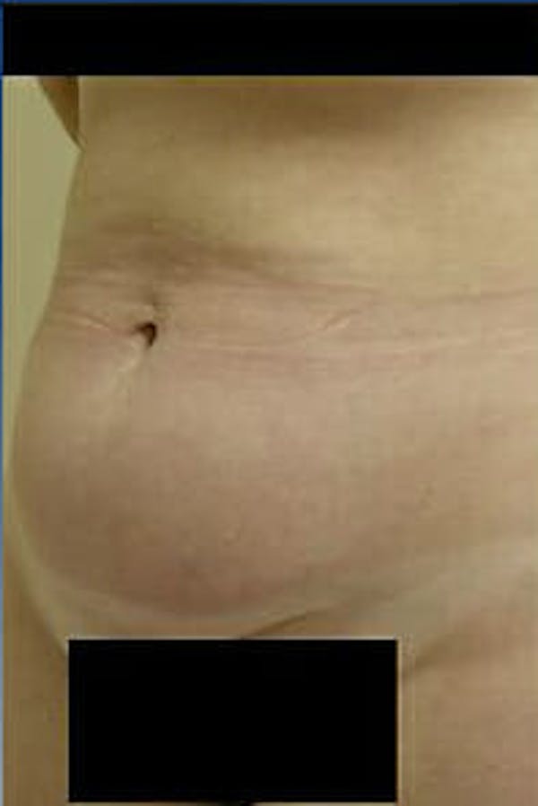 Tummy Tuck Before & After Gallery - Patient 9605609 - Image 3
