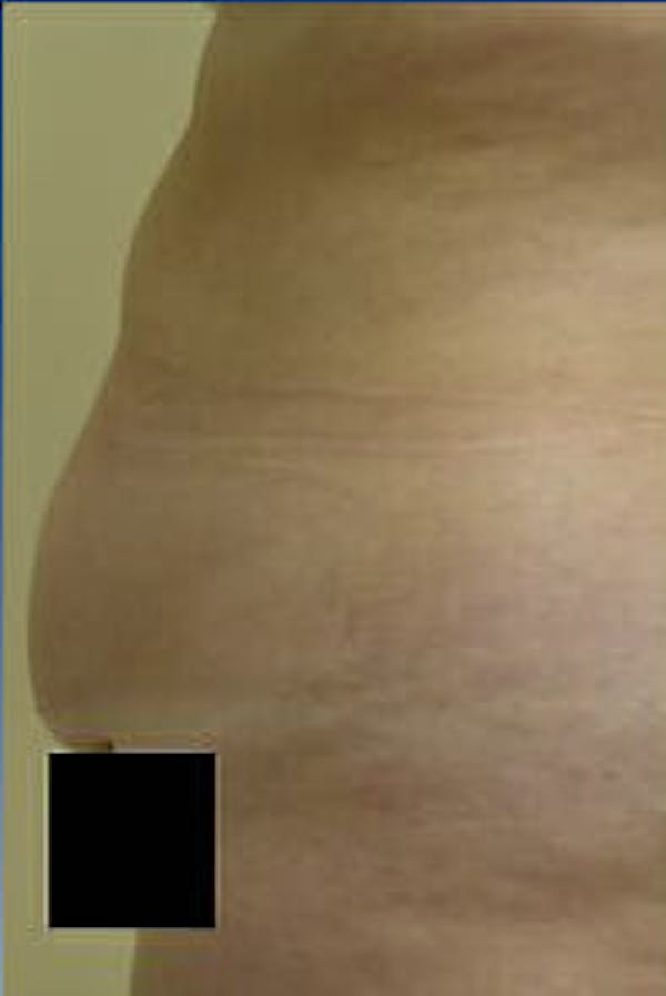Tummy Tuck Before & After Gallery - Patient 9605609 - Image 5