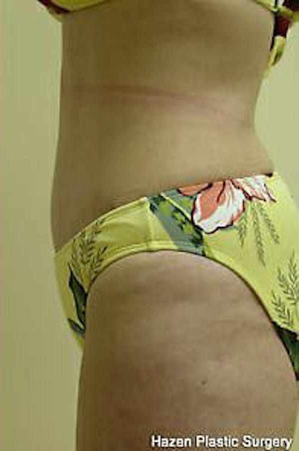 Tummy Tuck Before & After Gallery - Patient 9605609 - Image 6