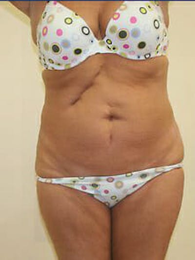 Tummy Tuck Before & After Gallery - Patient 9605612 - Image 1