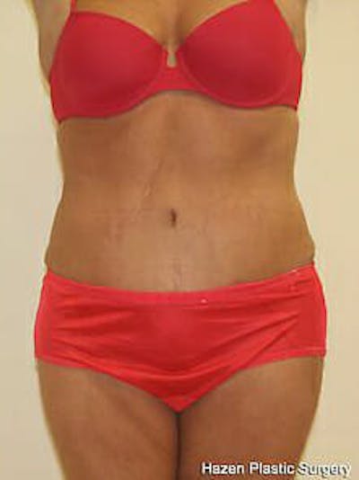 Tummy Tuck Before & After Gallery - Patient 9605612 - Image 2
