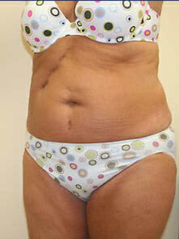 Tummy Tuck Gallery - Patient 9605612 - Image 3